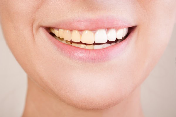 Can Laser Whitening Target Specific Types of Stains Better Than Strips Hastings