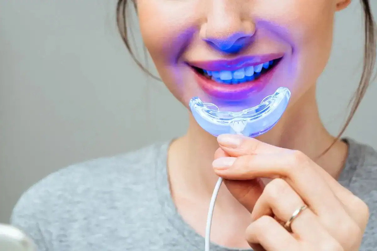 Can Laser Whitening Correct Deep or Intrinsic Discolouration Hastings