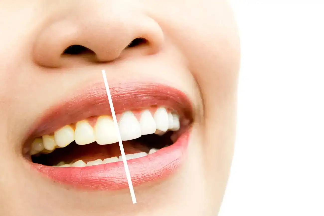Can Laser Whitening Fix Uneven Tooth Discolouration Hastings